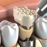 What Happens If I Don’t Have A Bone Grafting Procedure Before My Dental Implants Are Placed?