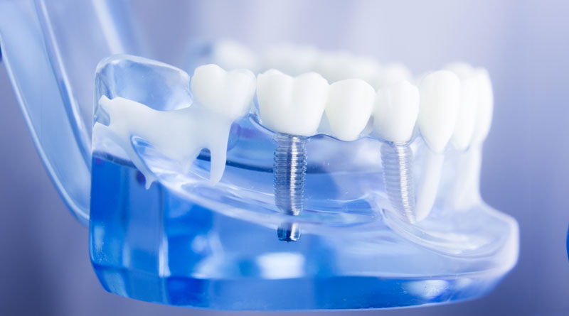 Revolutionize Your Smile: A Journey Through Whole Set of Teeth Implants