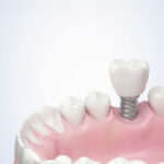 Complete Teeth Replacement: The Perks of Dental Implants Explained