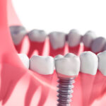 Unraveling the Complexities: Complications in Implant Dentistry