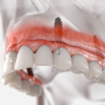 Navigating the Path to Smile Restoration: Unveiling the Secrets of Implants of Teeth
