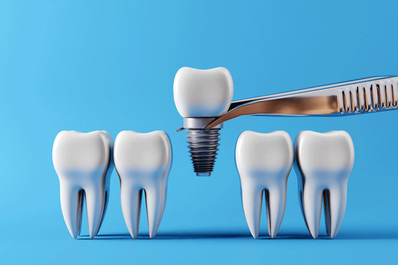 Unlock the Benefits of Dental Implants: Your Best Teeth Replacement Option