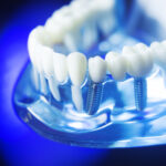 Exploring Options for Replacing Missing Teeth: A Look into Dental Implants