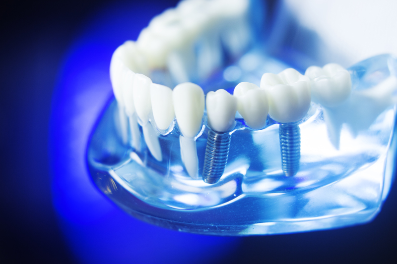 Exploring Options for Replacing Missing Teeth: A Look into Dental Implants