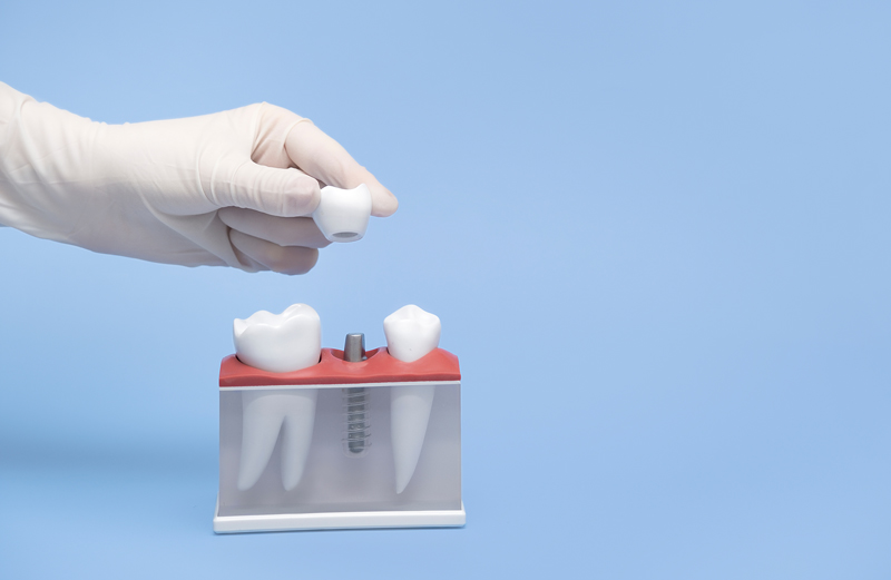 Enhancing Your Smile: The Power of Implanting a Back Tooth