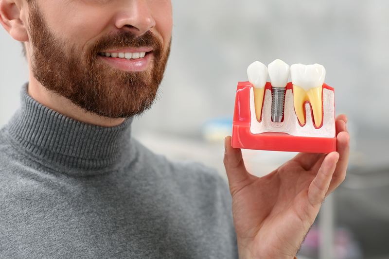 Understanding Dental Implants: What Exactly is the Abutment?