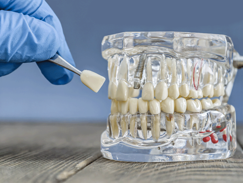 Discover Your Options for Replacement Teeth: An In-Depth Look at Dental Implants